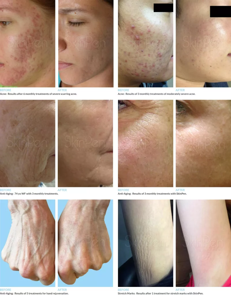 SkinPen kezelés előtt és után