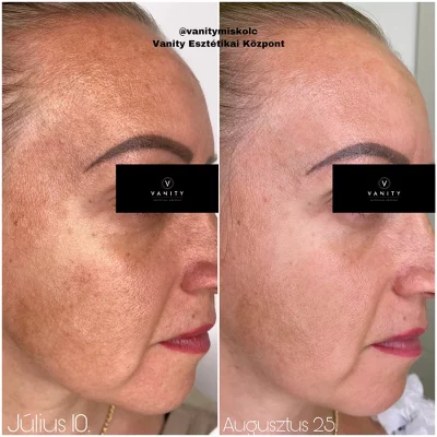 Egyenetlen bőrszín, textúra