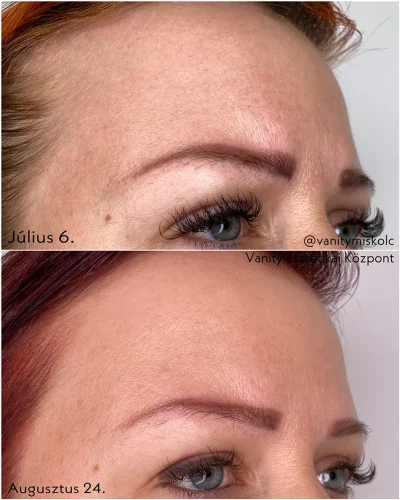 Egyenetlen bőrszín, textúra