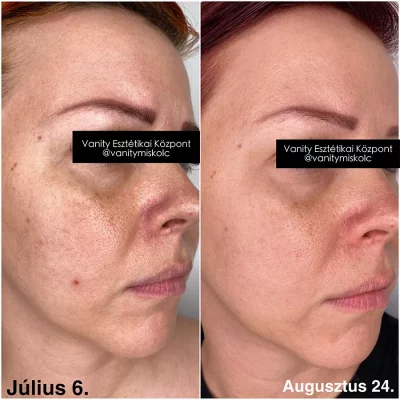 Tág pórus, egyenetlen textúra és bőrszín