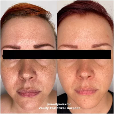 Egyenetlen bőrszín, textúra