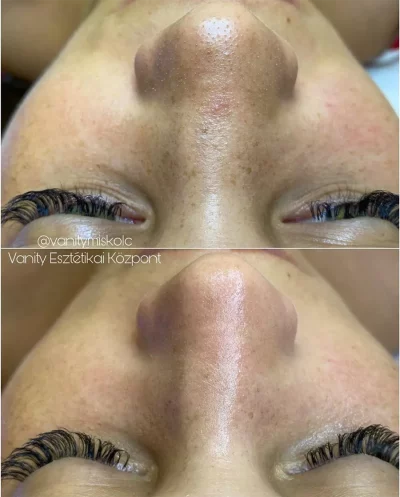 ZO Red Carpet kezelés előtt-után