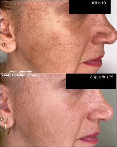 Egyenetlen bőrszín, textúra