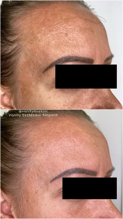 Egyenetlen bőrszín, textúra