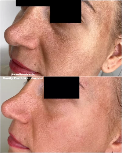 Egyenetlen bőrszín, textúra