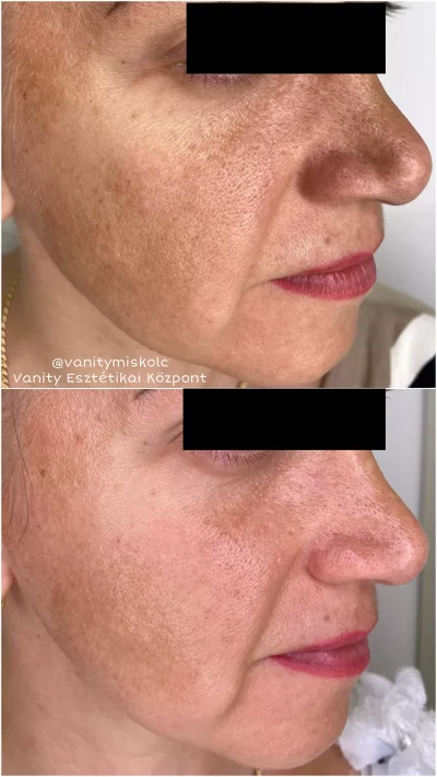 Egyenetlen bőrszín, textúra