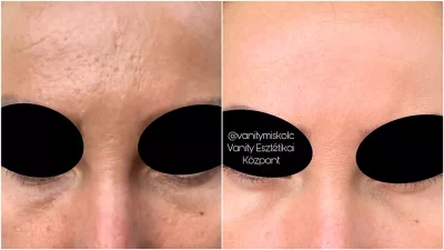 Egyenetlen bőrfelszín