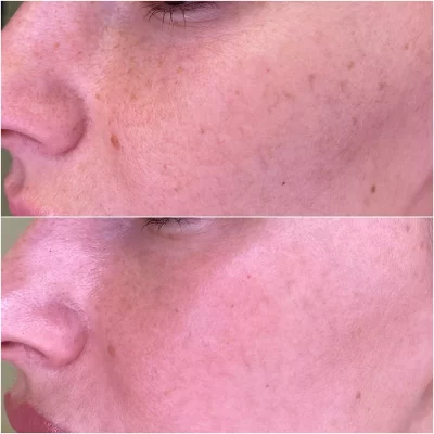 Egyenetlen bőrszín, finom ráncok