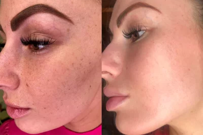 Egyenetlen bőrszín